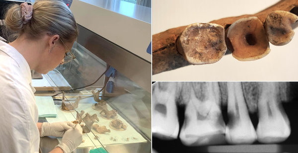 Шведские учёные доказали существование викингов-стоматологов